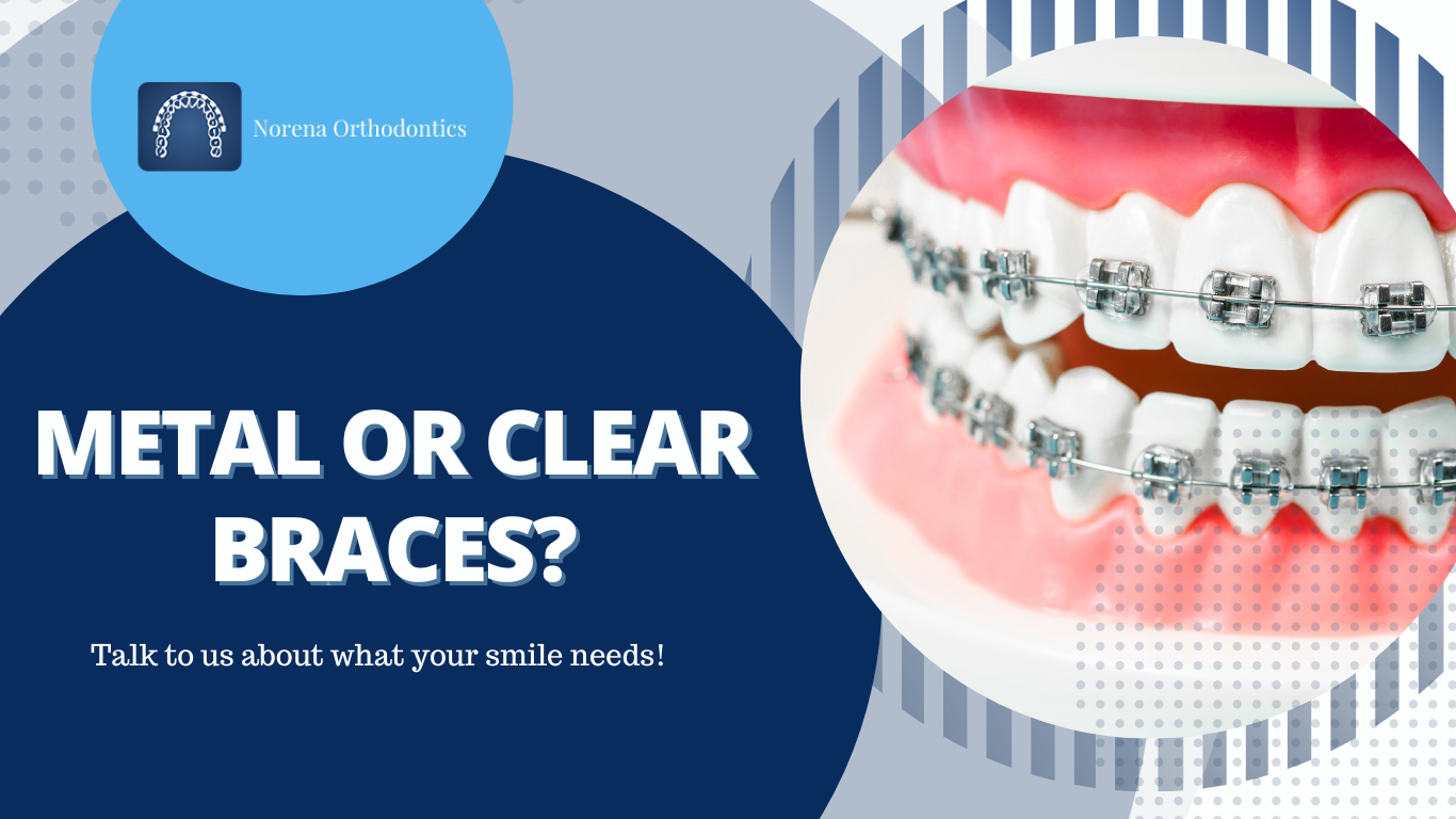 Metal Or Clear Braces In Plantation FL